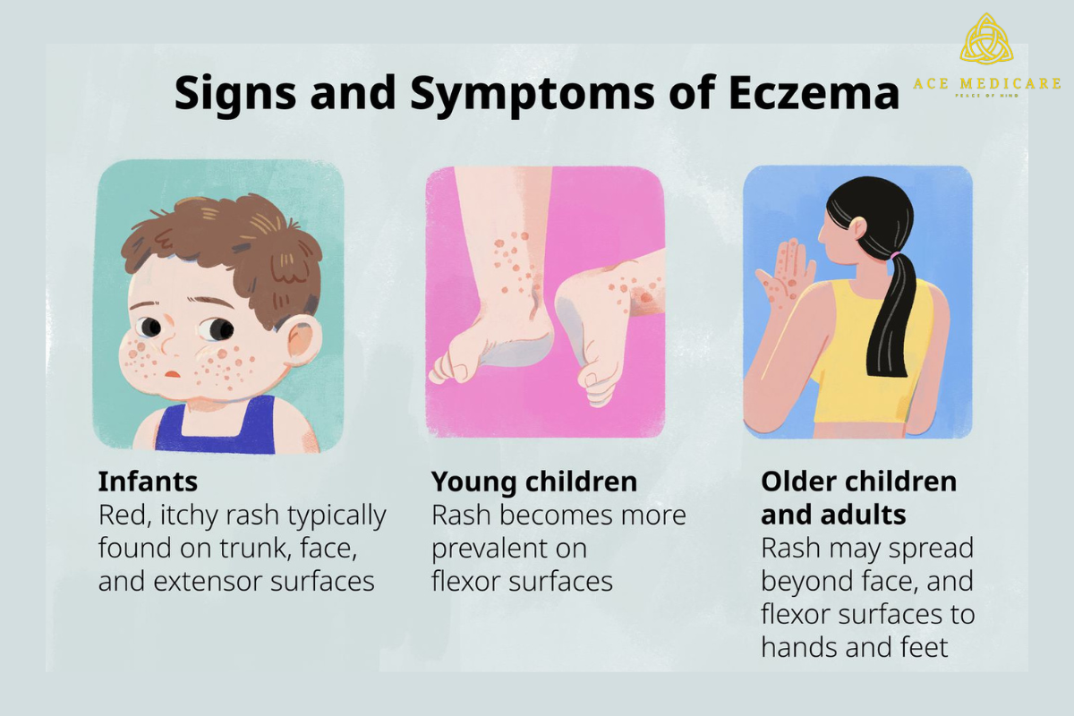 Understanding Eczema in Children: Causes, Symptoms, and Treatment